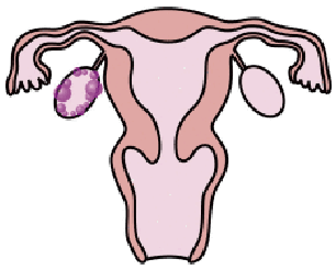 漢方 多 症候群 性 嚢胞 卵巣